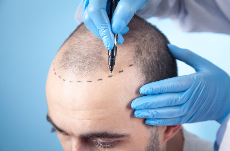 AT WHAT AGE SHOULD A PERSON GET A HAIR TRANSPLANT?