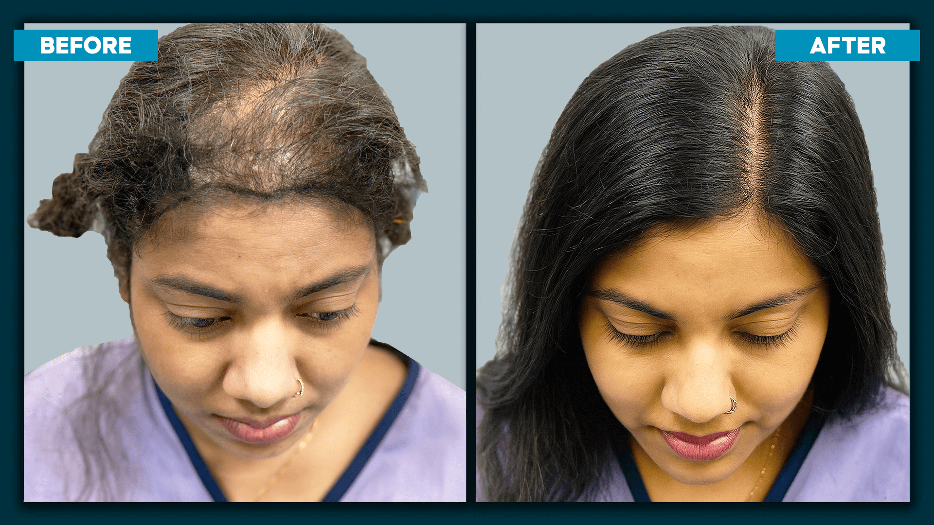 Female hair Transplant_1