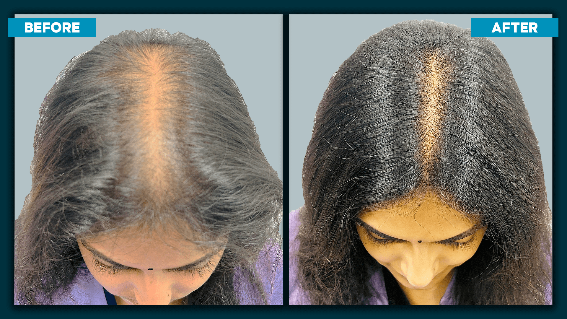 Female hair Transplant_2