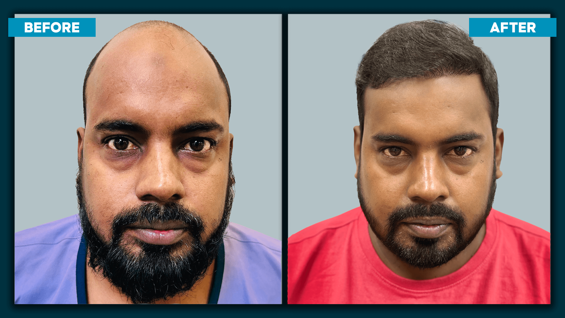 Fue Hair Treatment_1