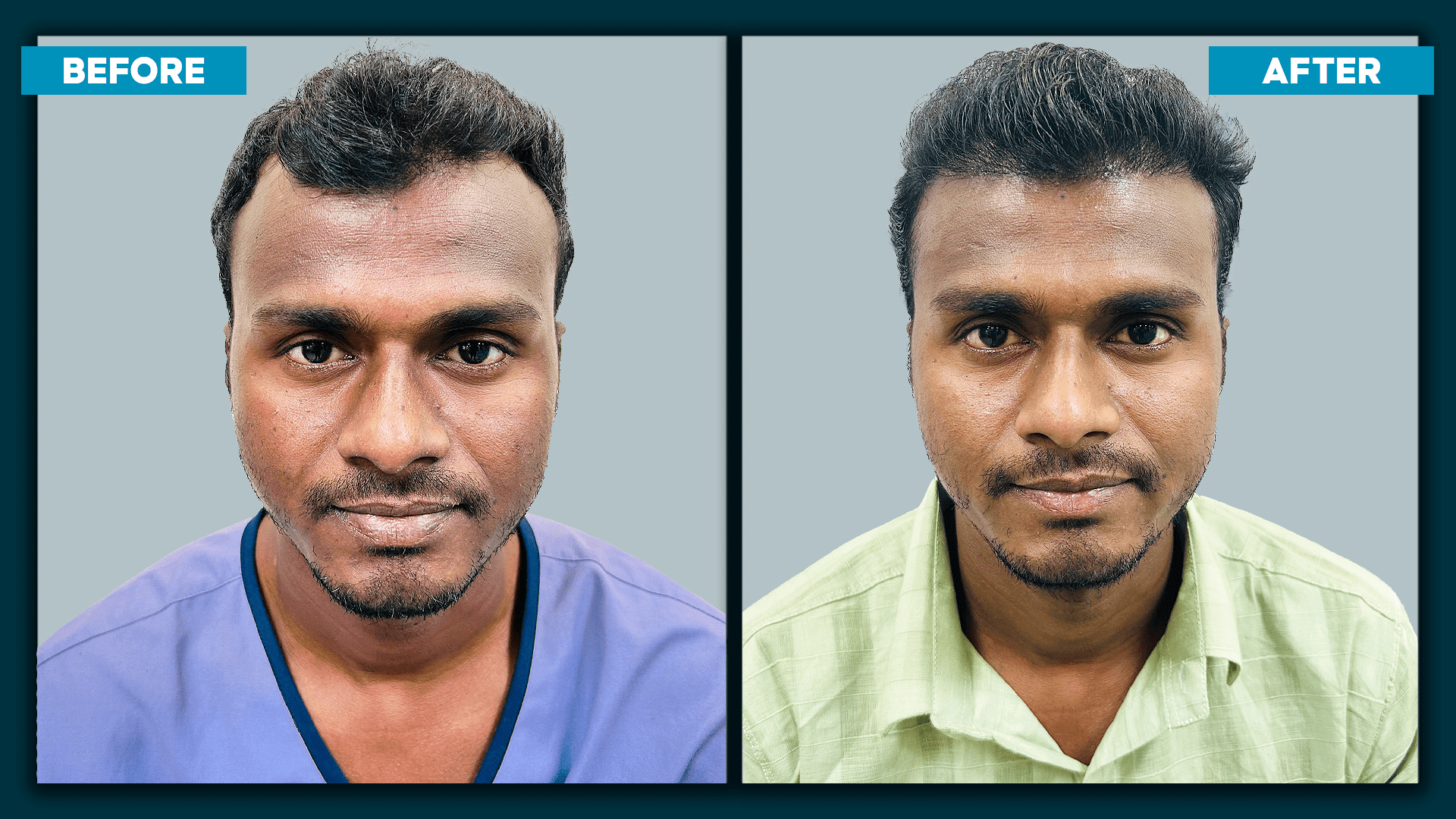 Fue Hair Treatment_2