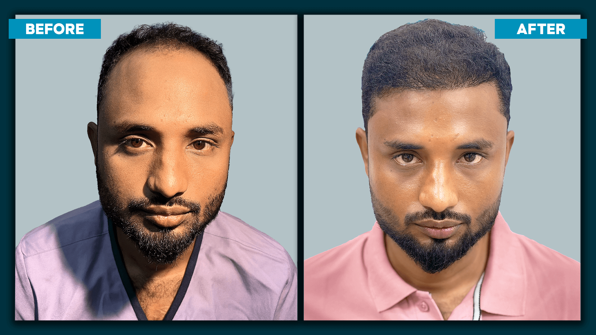 Fue Hair Treatment_3