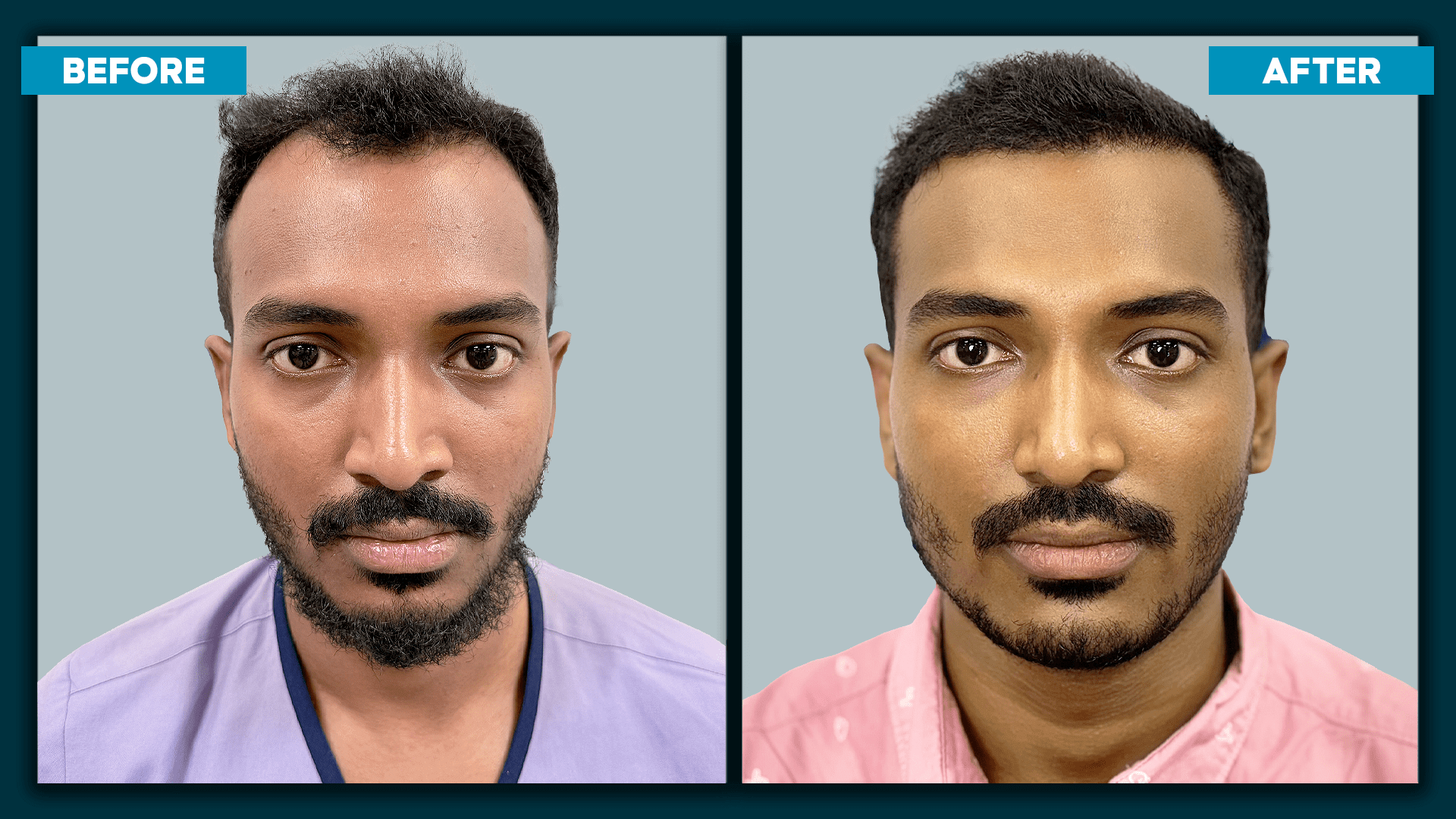 Fue Hair Treatment_4