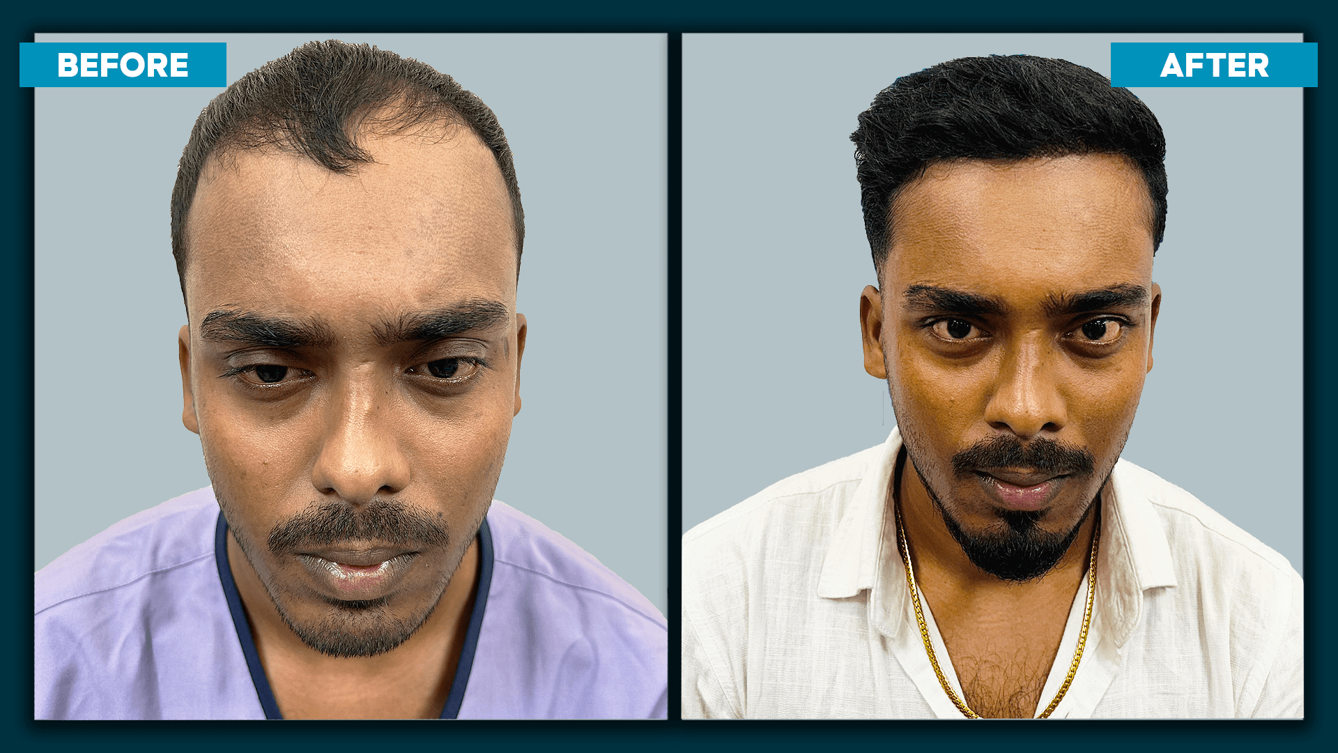 Real time hair transplant_slide_1