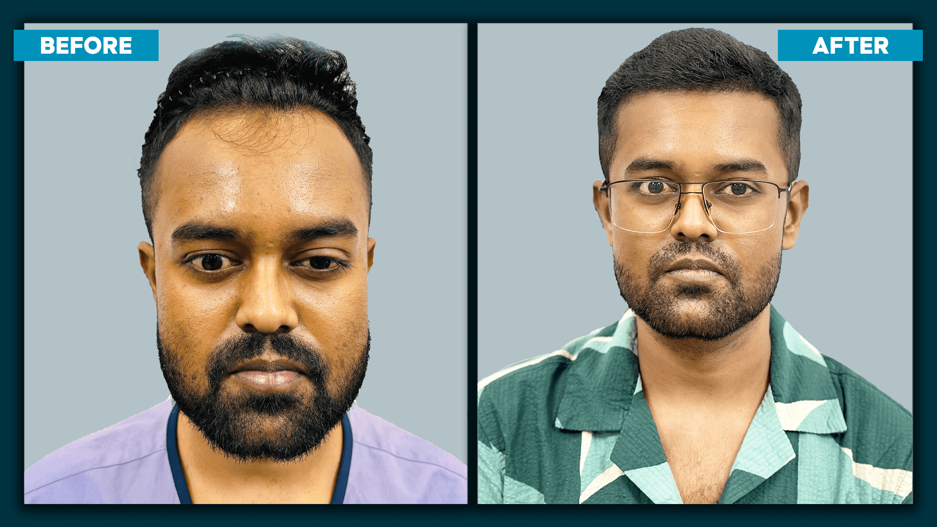 Real time hair transplant_slide_2