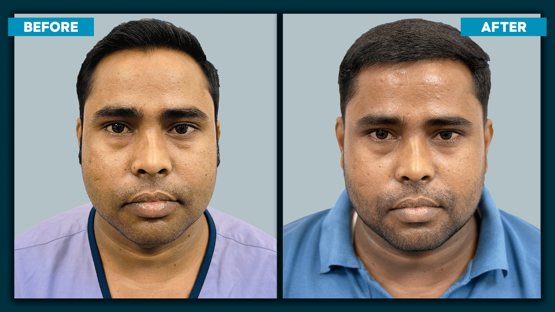 Real time hair transplant_slide_3