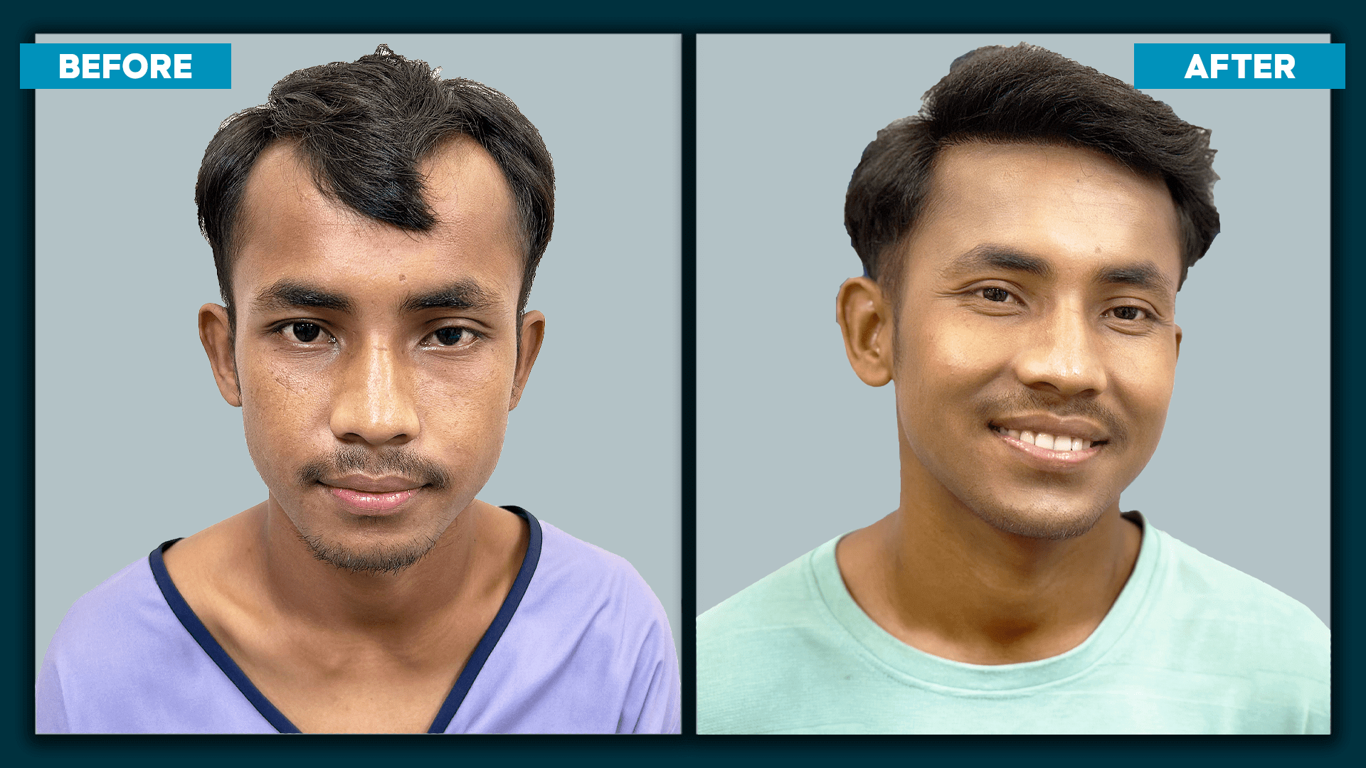 Real time hair transplant_slide_4