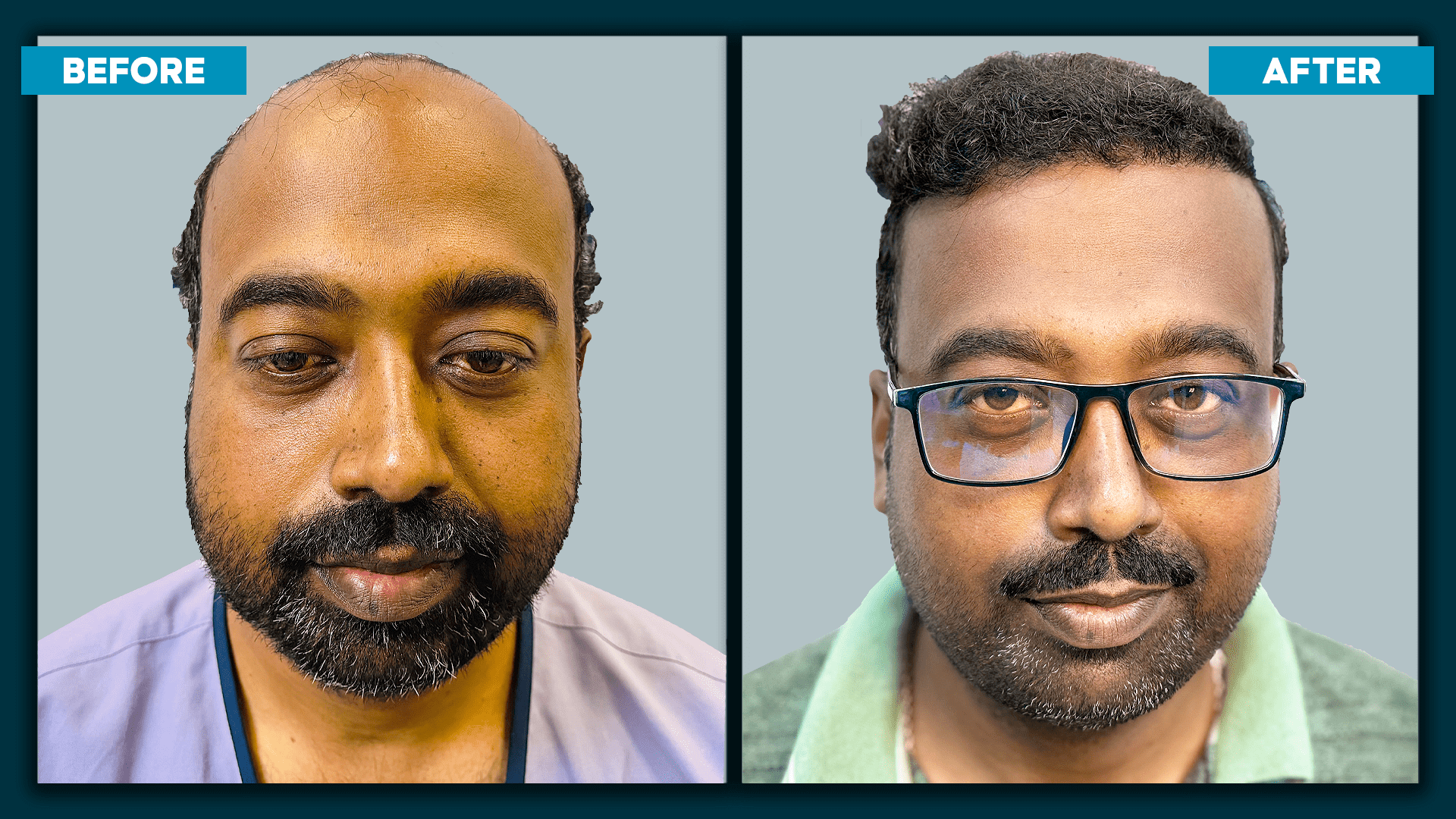 Real time hair transplant_slide_5