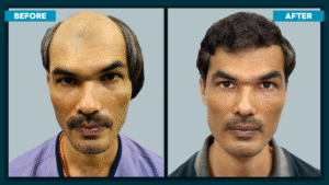 Permanent hair transplant cost