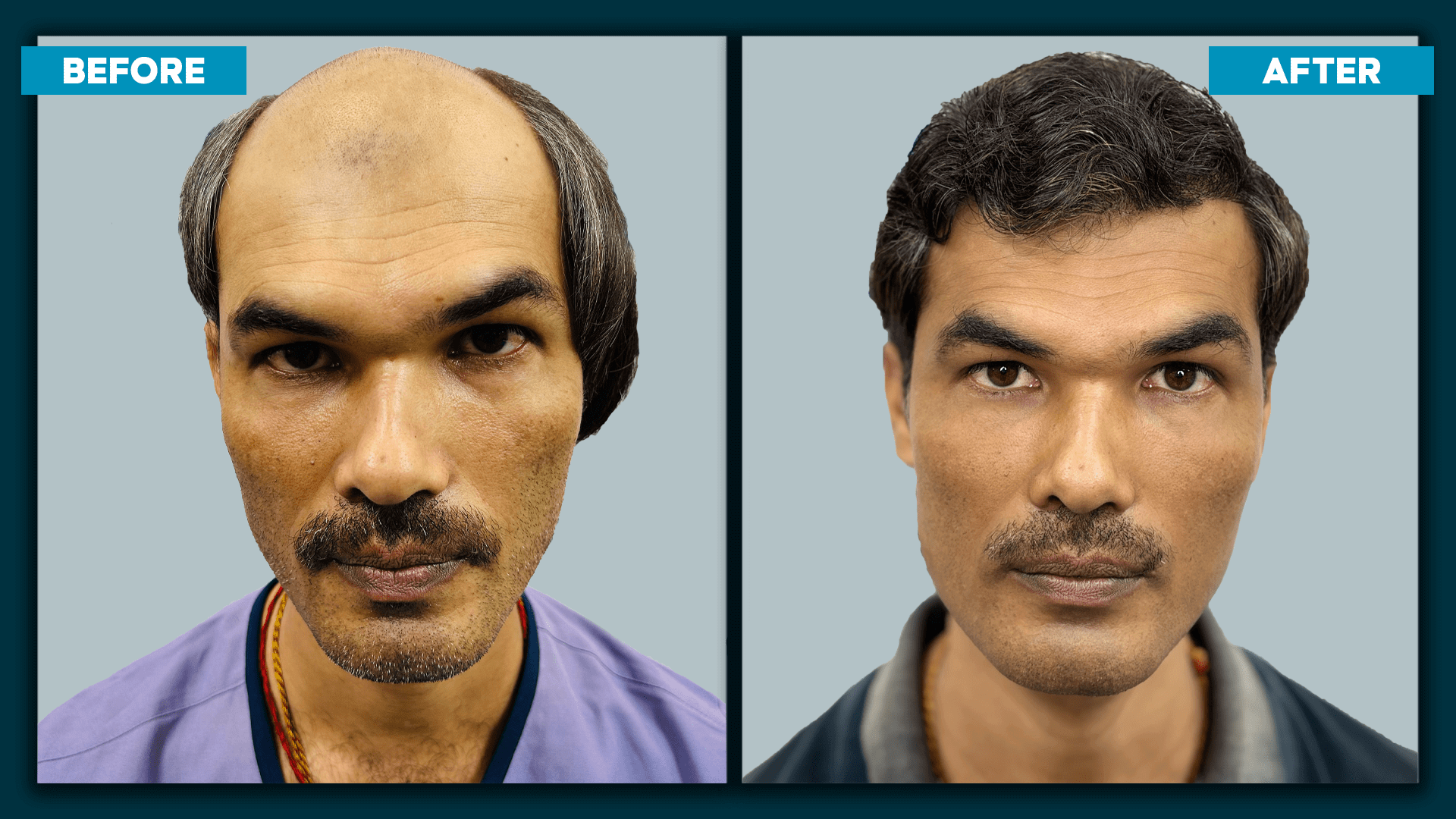 Real time hair transplant_slide_6