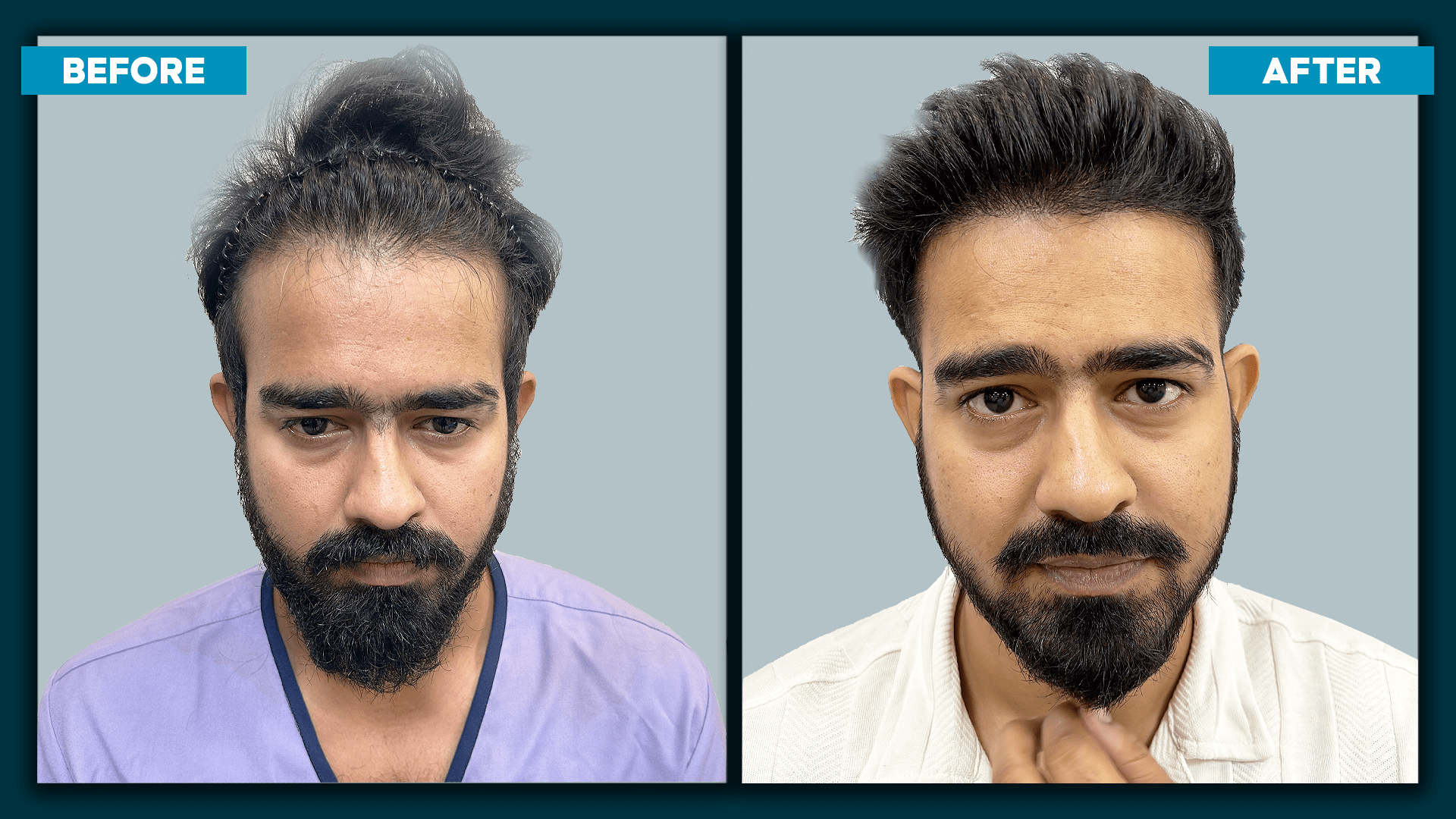 Sapphire hair transplant_slide_1