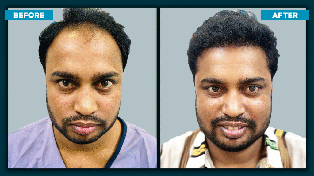hair transplant price.