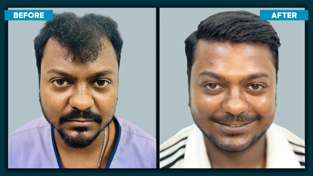 Crown Hair Transplant
