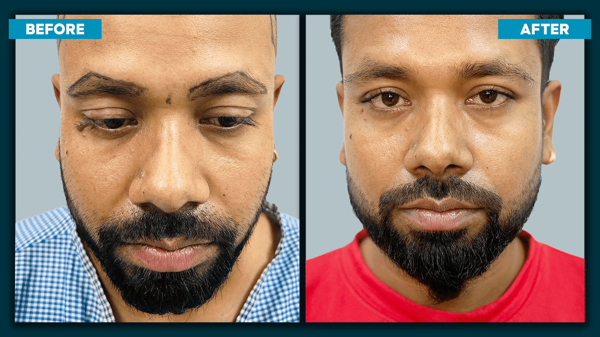 eye brow transplant_1