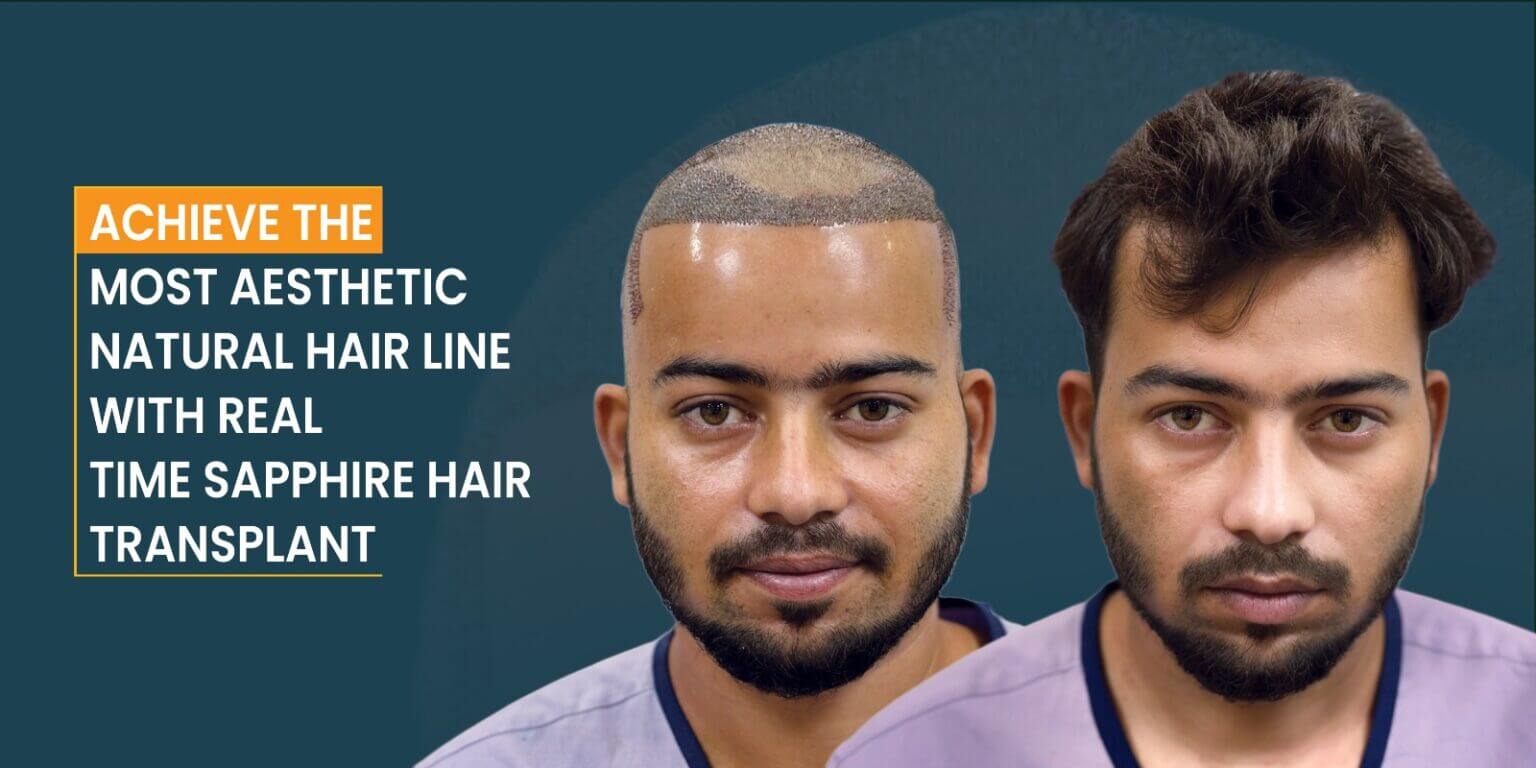 Hair Transplant in kolkata