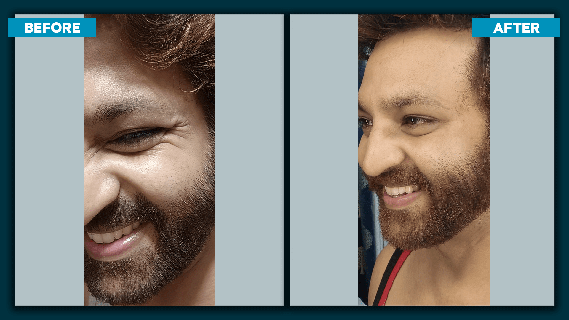 Botox_before&after_1