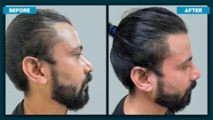 Hair Transplant in Kolkata