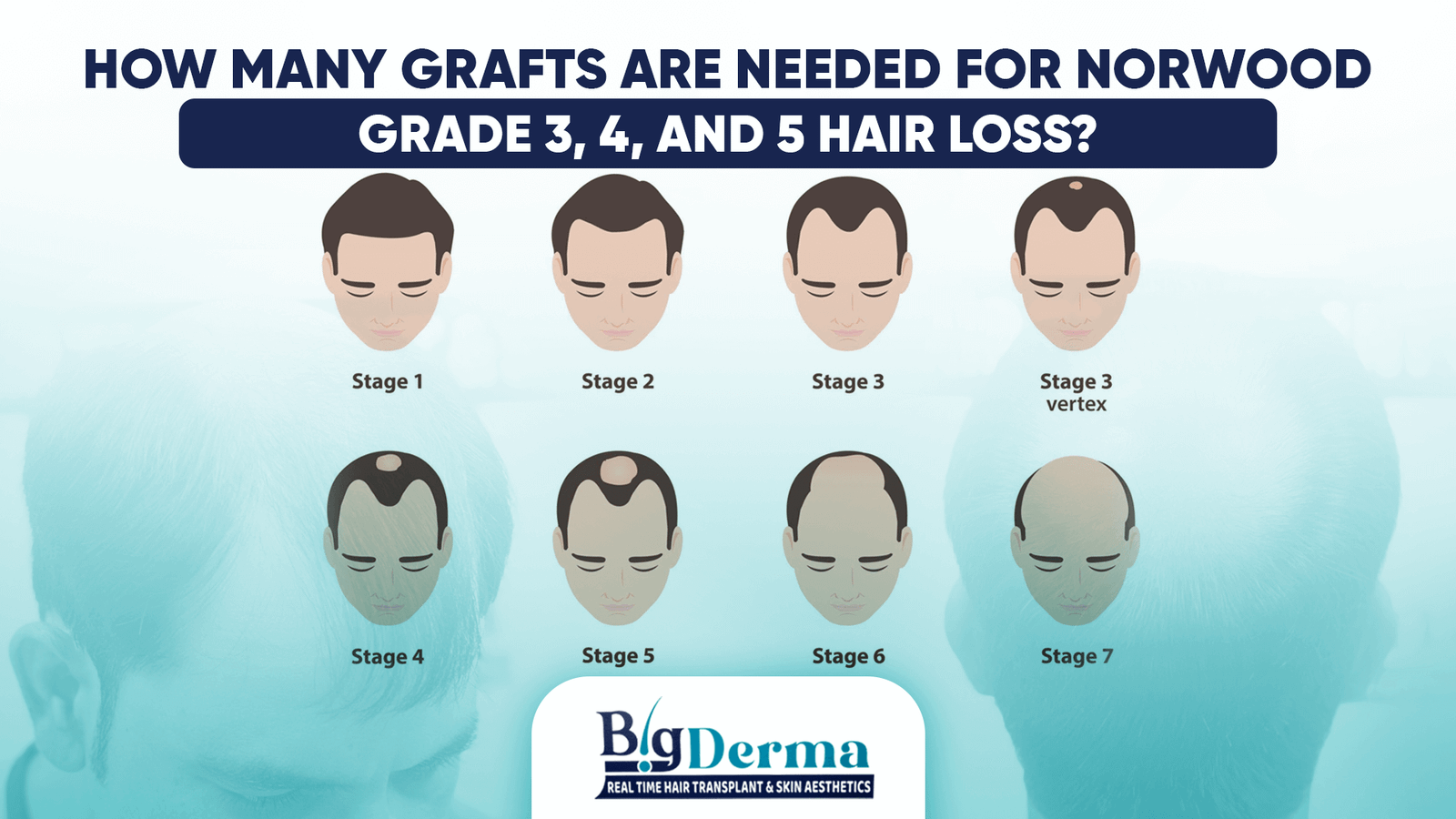 How Many Grafts Are Needed for Norwood Grade 3, 4, and 5 Hair Loss ...