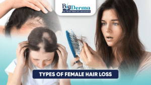 Types of Female Hair Loss