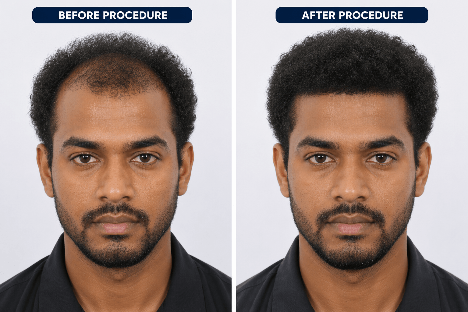 Afro hair transplant