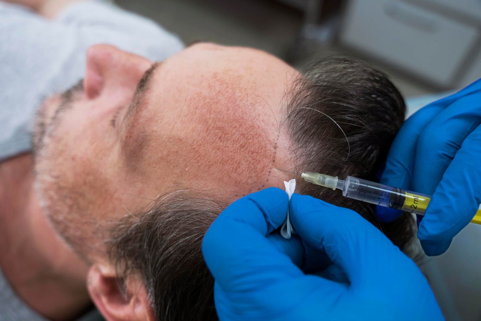 Hair Transplant Cost